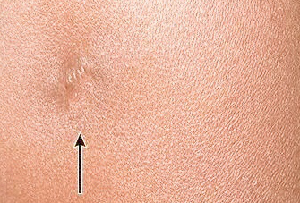 寶寶打過(guò)卡介苗的地方紅腫化膿了，該怎么辦？